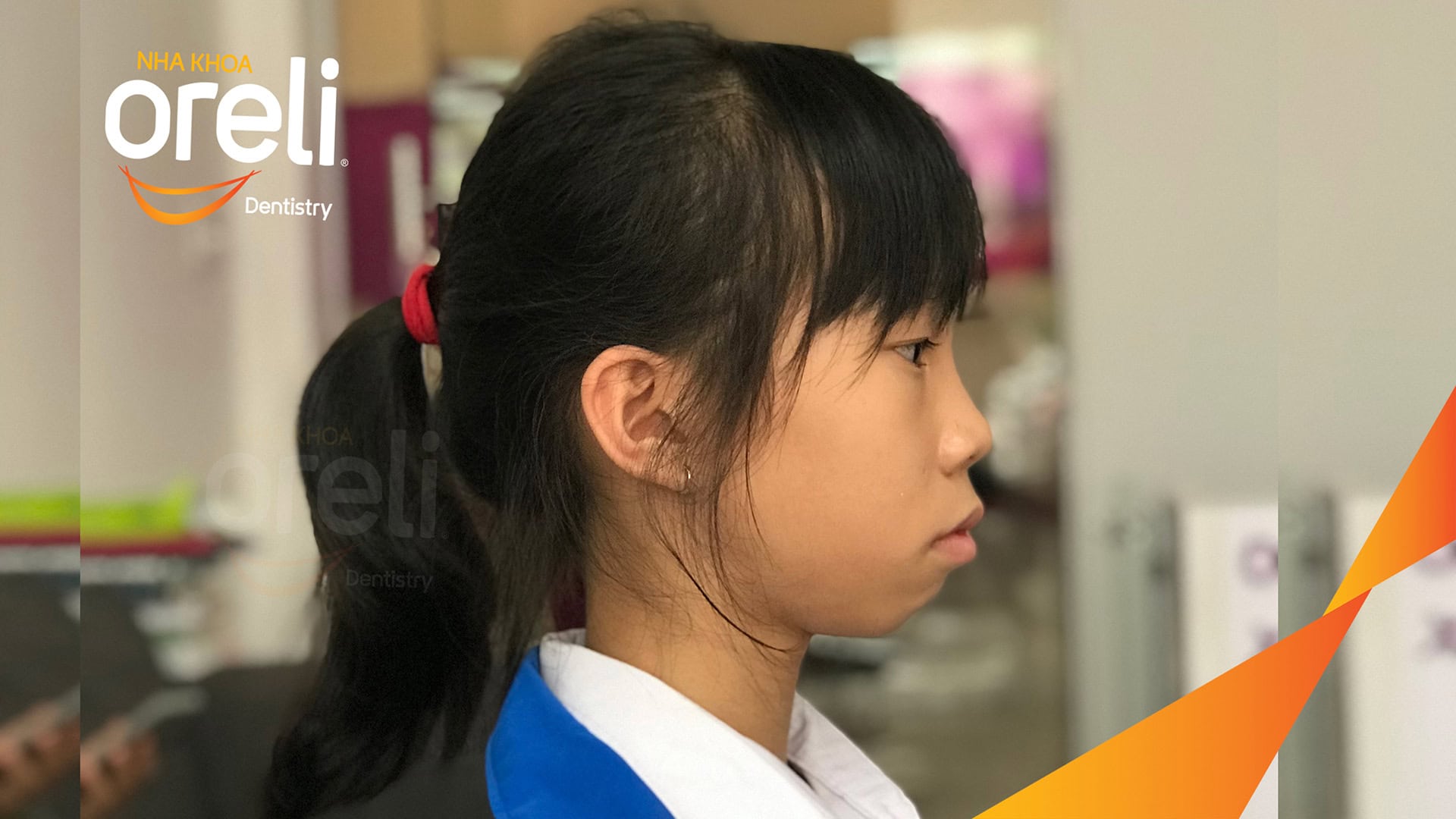 Trước điều trị niềng răng Oreli